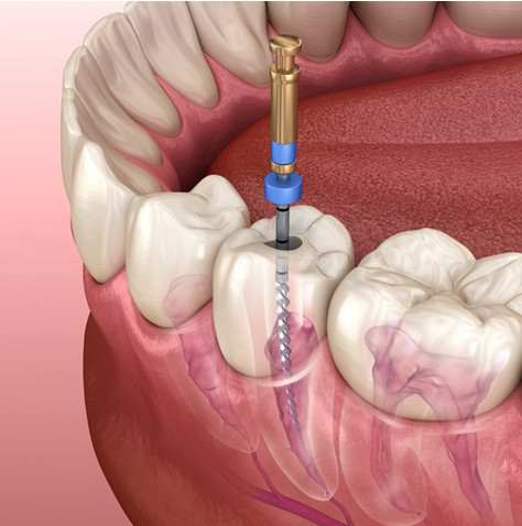 The Root Canal; A Mainstay In The Dental Clinic